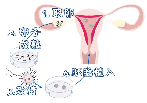 染色体易位案例